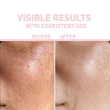 Bionnex The Nordea Pore and Blemish Control Niacinamide Serum For All Skin Types