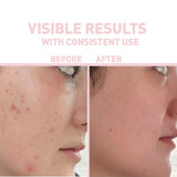 ACIDE SALICYLIQUE 2% + ISLAND LICHEN NETTOYANT