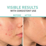 Bionnex Rensaderm Repairing & Sebum Control Cream For Oily & Acne-Prone Skin